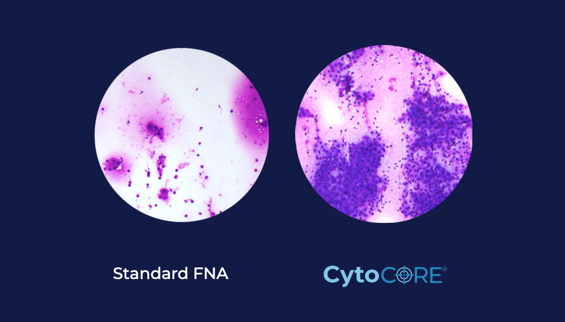 Standard FNA vs. CytoCore